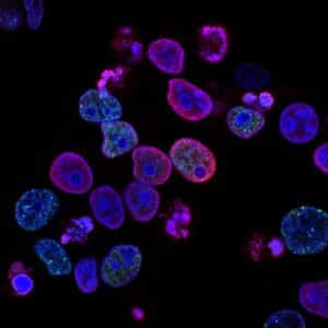 Health Benefits of Keto Diet - treating cancer